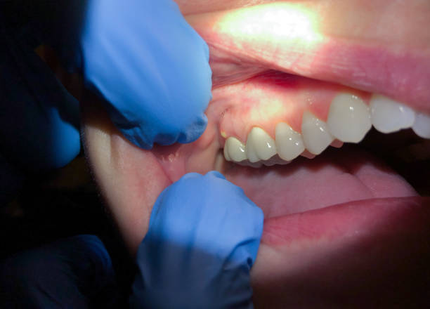 Best Broken or Cracked Tooth Emergency Dentist in Bratenahl, OH